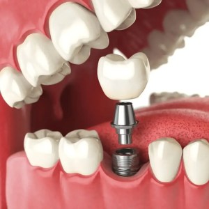 mejor dentista en miami, carillas de porcelana en miami, Botox miami, costo del tratamiento de conducto en miami, elevación de seno nasal en miami, mejores carillas en miami, mejor dentista del sur de florida, mejor dentista cosmético en miami, mejor atención dental en miami, sage dental