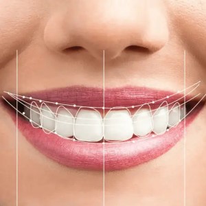 mejor dentista en miami, carillas de porcelana en miami, Botox miami, costo del tratamiento de conducto en miami, elevación de seno nasal en miami, mejores carillas en miami, mejor dentista del sur de florida, mejor dentista cosmético en miami, mejor atención dental en miami, sage dental
