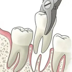 mejor dentista en miami, carillas de porcelana en miami, Botox miami, costo del tratamiento de conducto en miami, elevación de seno nasal en miami, mejores carillas en miami, mejor dentista del sur de florida, mejor dentista cosmético en miami, mejor atención dental en miami, sage dental