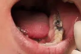 carillas, carillas, más barato, miami, kendall, centro de la ciudad, playa sur, fiu, más cercano a mí, dentista cerca de mí, dentista cerca de mi, mejor dentista miami, mejor dentista miami, pizza cerca de mí, chino cerca de mí, comida cerca de mí, corona dentista miami, dentista más barato miami, dentista de conducto radicular miami, conducto radicular más barato de miami